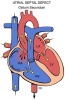 atrial septal defekt / #130632